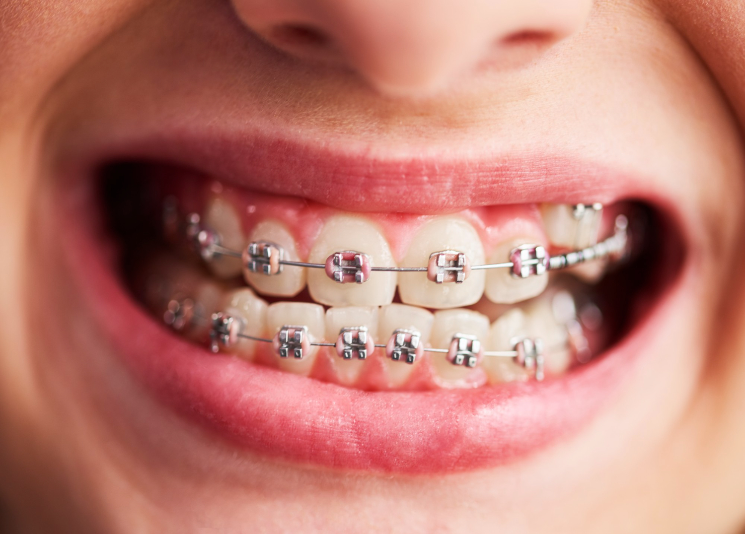 quanto custa colocar um aparelho nos dentes em Moçambique